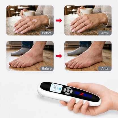 ZJKZTOP 308nm Handheld UVB Light Therapy Device