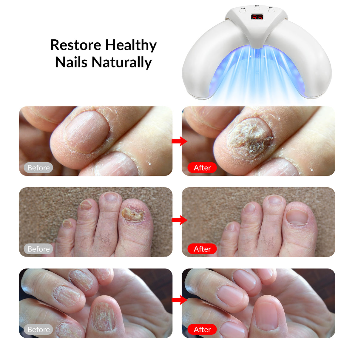 45W 905nm Foldable Nail Fungus Treatment Device 22 LEDs