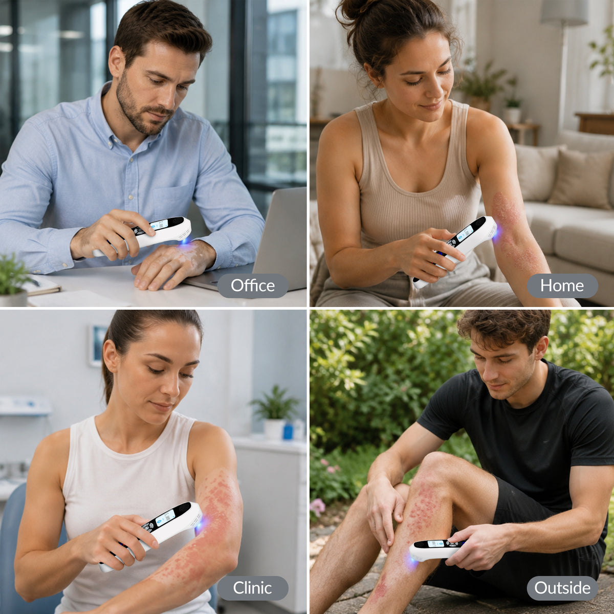 ZJKZTOP 308nm Handheld UVB Light Therapy Device