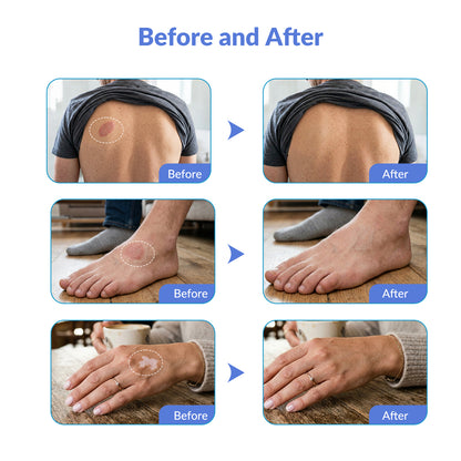 Portable 308nm UVB Phototherapy Wand for Vitiligo